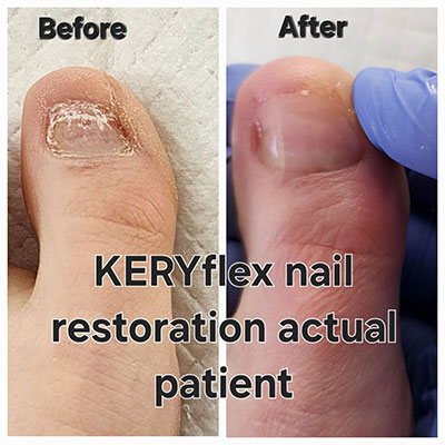 keryflex before and after