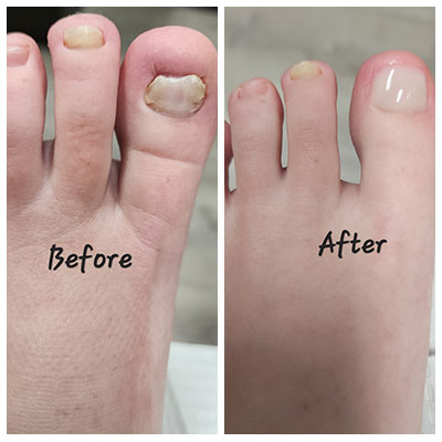 keryflex before and after