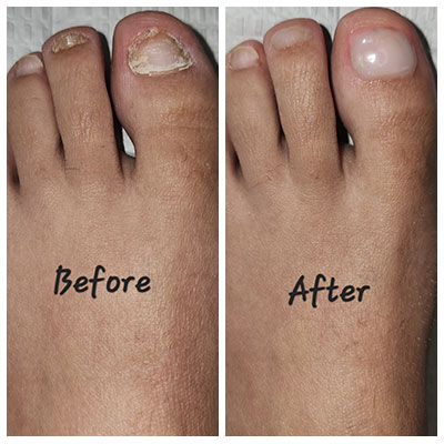 keryflex before and after