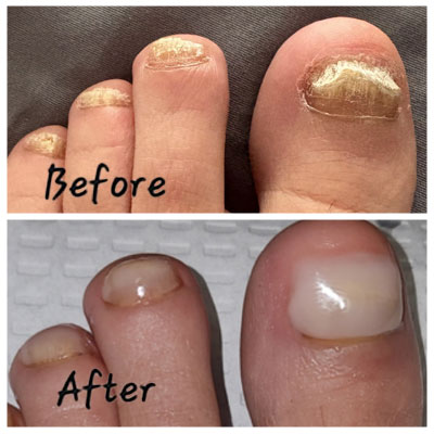 keryflex before and after