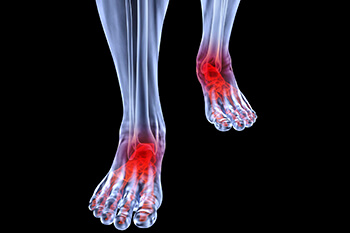 arthritic foot care in the Passaic County, NJ: Clifton (Paterson, Passaic, Wayne, Hawthorne, Clifton), Essex County, NJ: Newark, East Orange, Bloomfield, West Orange, Belleville, Nutley, Montclair, Bergen County, NJ: Rutherford, Garfield and Morris County, NJ: Lincoln Park, Lincoln Park areas