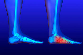 flat feet treatment in the Passaic County, NJ: Clifton (Paterson, Passaic, Wayne, Hawthorne, Clifton), Essex County, NJ: Newark, East Orange, Bloomfield, West Orange, Belleville, Nutley, Montclair, Bergen County, NJ: Rutherford, Garfield and Morris County, NJ: Lincoln Park, Lincoln Park areas