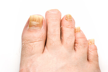 Fungal toenails, toenail fungus diagnosis and treatment in the Passaic County, NJ: Clifton (Paterson, Passaic, Wayne, Hawthorne, Little Falls, Totowa) and Essex County, NJ: Newark, East Orange, Bloomfield, West Orange, Belleville, Nutley areas