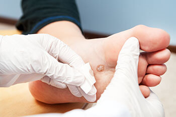 plantar warts treatment in the Passaic County, NJ: Clifton (Paterson, Passaic, Wayne, Hawthorne, Clifton), Essex County, NJ: Newark, East Orange, Bloomfield, West Orange, Belleville, Nutley, Montclair, Bergen County, NJ: Rutherford, Garfield and Morris County, NJ: Lincoln Park, Lincoln Park areas